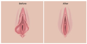 surgery diagram before and after after Labiaplasty in Brooklyn, Greenwich, CT, Manhasset, Manhattan, NYC, and Ridgefield, NJ